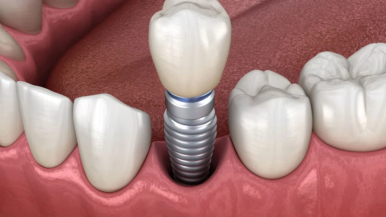 Common Dental Implant Issue